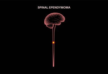 Spinal ependymoma poster. Intramedullary neoplasm on mri or ct scan. Glial spinal cord tumor. Primary central nervous system disease. Inflammation in brain or spinal cord medical vector illustration clipart