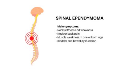 Omurilik ependimomu belirtileri. Kadın siluetinde intrameduller neoplazma. Glial omurilik tümörü. Birincil merkezi sinir sistemi hastalığı. Beyinde iltihap ya da omurilik vektör çizimi
