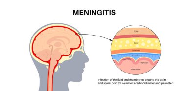 Beyni ve omuriliği çevreleyen koruyucu tabakalarda menenjit iltihabı. Menteşe yapısı, baş ağrısı teşhisi ve tedavi. İnsan baş vektöründe bakteri, virüs ve mantar