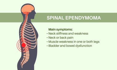 Spinal ependymoma symptoms. Intramedullary neoplasm in female silhouette. Glial spinal cord tumor. Primary central nervous system disease. Inflammation in the brain or spinal cord vector illustration clipart