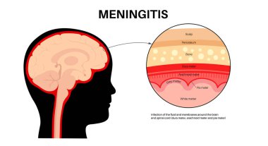 Meningitis inflammation of the protective layers surrounding the brain and spinal cord. Meninges disease medical poster. Bacteria, viruses, fungi, parasites in the baby head flat vector illustration clipart