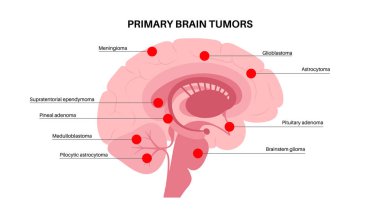 Birincil beyin tümörü posteri. Menenjiyom, gliyoblastom, hipofiz ve epifiz tümörü. Beyincik medulloblastom ve pilositik astrositom kanseri. Beyin sapı düz vektör bilgisinde neoplazma