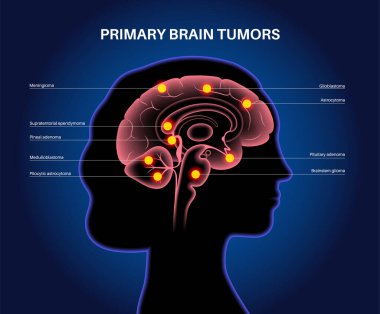 Birincil beyin tümörü posteri. Menenjiyom, gliyoblastom, hipofiz ve epifiz tümörü. Beyincik medulloblastom ve pilositik astrositom kanseri. Beyin sapı ct veya MRI tarama vektöründeki Neoplazma