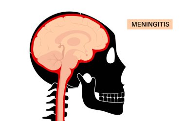 Beynin koruyucu katmanları ve omuriliğinde menenjit akut ya da kronik iltihaplanma. Meninges hastalığı posteri. Bakteriler, virüsler, mantarlar, parazitler insan kafası düz vektör illüstrasyonunda