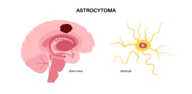 Astrositom beyin veya omurilik tümörü. Astrolit hücreleri mikroskop altında. Kişilik değişiklikleri, nöbetler, baş ağrıları ve mide bulantısı. MRI veya CT vektörü gibi kanser patolojisi, derecelendirme ve teşhis yöntemleri