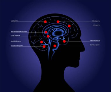 Birincil beyin tümörü posteri. Menenjiyom, gliyoblastom, hipofiz ve epifiz tümörü. Beyincik medulloblastom ve pilositik astrositom kanseri. Beyin sapı ct veya MRI tarama vektöründeki Neoplazma