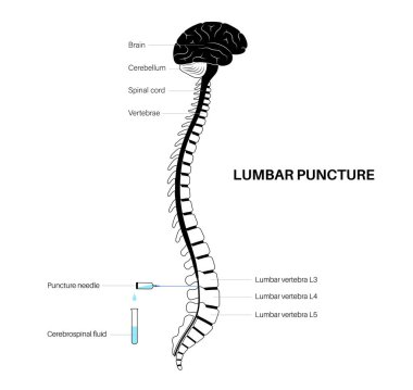 Bel ponksiyonu tıbbi prosedürü. Omurilik sıvısı, serebrospinal sıvı toplama konsepti. İnsan omurgası, beyin ve omurilik vektörünün iki bel kemiği arasındaki boşluğa yerleştirilmiş iğne.