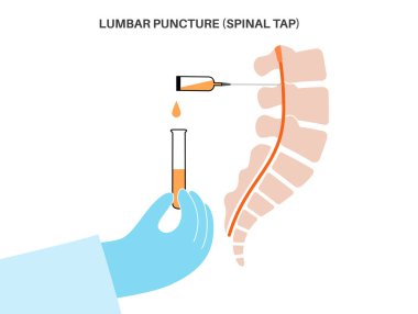 Bel ponksiyonu tıbbi prosedürü. Klinikte omurilik sıvısı, serebrospinal sıvı toplama. İnsan omurgası düz vektör illüstrasyonunun iki bel kemiği arasındaki boşluğa yerleştirilmiş iğne..