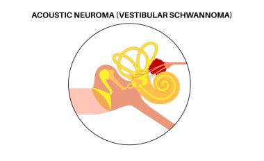 Acoustic neuroma non cancerous brain tumour. Vestibular schwannoma in the human head around vestibular apparatus. Otolaryngology clinic, diagnosis, treatment and surgery vector medical illustration clipart