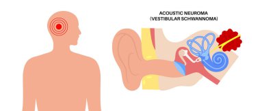 Acoustic neuroma non cancerous brain tumour. Vestibular schwannoma in the human head around vestibular apparatus. Otolaryngology clinic, diagnosis, treatment and surgery vector medical illustration clipart