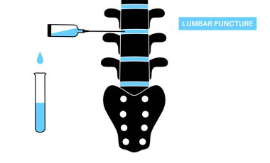 Bel ponksiyonu tıbbi prosedürü. Klinikte omurilik sıvısı, serebrospinal sıvı toplama. İnsan omurgası düz vektör illüstrasyonunun iki bel kemiği arasındaki boşluğa yerleştirilmiş iğne..