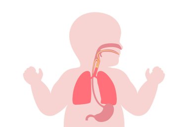 Bebekte aspirasyon zatürresi. Sıvı ve yiyeceklerle hava yollarının tıkanması, iltihap ve akciğerlerde enfeksiyon. Yutma problemleri ve solunum sistemi hastalığı tıbbi düz vektör çizimi