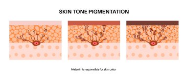 İnsan derisi posterinde Melanin. Melanositler cilt açık veya koyu pigmentasyonu üretirler. Zararlı ultraviyole ışınları emmek, ciltteki hücreleri korumak ve üst deriyi güneş hasarlı düz vektör çizimlerinden korumak.