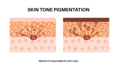 İnsan derisi posterinde Melanin. Melanositler cilt açık veya koyu pigmentasyonu üretirler. Zararlı ultraviyole ışınları emmek, ciltteki hücreleri korumak ve üst deriyi güneş hasarlı düz vektör çizimlerinden korumak.
