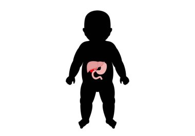 Yeni doğmuş bir bebekte safra kesesi atrezisi. Safra kesesi kanalları, karaciğer ve safra kesesi fibrozu tıkanmış. HIDA taraması hepatoloji, gastroenteroloji ve pediatrik patolojiyle ilgili düz vektör çizimi.