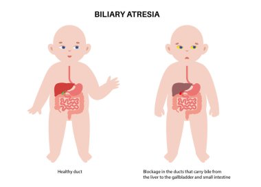 Yeni doğmuş bir bebekte safra kesesi atrezisi. Sağlıklı ve safra kanalları tıkalı. Safra kesesi, karaciğer, fibroz ya da siroz. Hepatoloji, gastroenteroloji ve pediatrik patolojiler, HIDA tarama vektör çizimi.