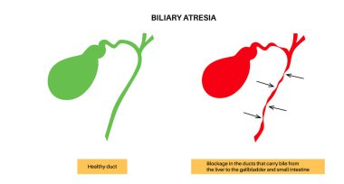Yeni doğmuş bir bebekte safra kesesi atrezisi. Sağlıklı ve safra kanalları tıkalı. Safra kesesi fibrozu ve kronik iltihap, HIDA taraması düz vektör çizimi. Hepatoloji, gastroenteroloji ve pediatrik patolojiler.