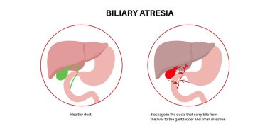 Yeni doğmuş bir bebekte safra kesesi atrezisi. Sağlıklı ve safra kanalları tıkalı. Safra kesesi, karaciğer, fibroz ya da siroz. Hepatoloji, gastroenteroloji ve pediatrik patolojiler, HIDA tarama vektör çizimi.