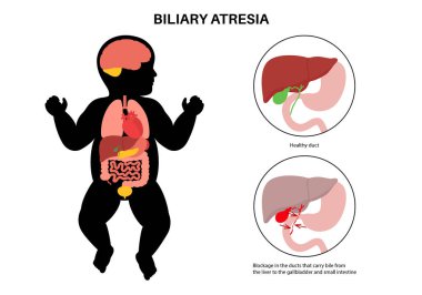 Yeni doğmuş bir bebekte safra kesesi atrezisi. Sağlıklı ve safra kanalları tıkalı. Safra kesesi, karaciğer, fibroz ya da siroz. Hepatoloji, gastroenteroloji ve pediatrik patolojiler, HIDA tarama vektör çizimi