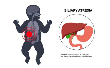 Yeni doğmuş bir bebekte safra kesesi atrezisi. Safra kesesi kanalları, karaciğer ve safra kesesi fibrozu tıkanmış. HIDA taraması hepatoloji, gastroenteroloji ve pediatrik patolojiyle ilgili düz vektör çizimi.