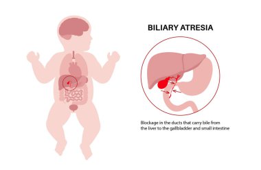 Yeni doğmuş bir bebekte safra kesesi atrezisi. Safra kesesi kanalları, karaciğer ve safra kesesi fibrozu tıkanmış. HIDA taraması hepatoloji, gastroenteroloji ve pediatrik patolojiyle ilgili düz vektör çizimi.