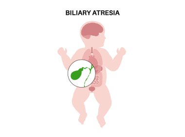 Yeni doğmuş bir bebekte safra kesesi atrezisi. Safra kesesi kanalları, karaciğer ve safra kesesi fibrozu tıkanmış. HIDA taraması hepatoloji, gastroenteroloji ve pediatrik patolojiyle ilgili düz vektör çizimi.