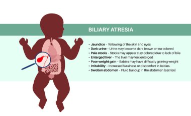 Yeni doğan semptomlar ve teşhiste safra kesesi atrezisi. Safra kesesi kanalları, karaciğer ve safra kesesi fibrozu tıkanmış. Gastroenteroloji ve pediatrik patolojiler, Düz vektör çizimi HIDA taraması