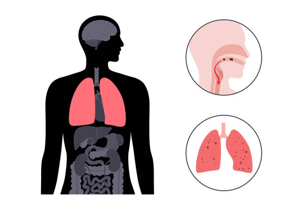 Аспирационная пневмония в организме человека. Блокировка дыхательных путей жидкостями или пищевыми продуктами, воспалением и инфекцией легких. Проблемы глотания, заболевание дыхательной системы, плоские векторные иллюстрации
