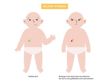 Sarılığı olan yeni doğmuş bir bebeğin safra kesesi atrezimi. Safra kesesi kanalları, karaciğer ve safra kesesi fibrozu tıkanmış. HIDA taraması hepatoloji, gastroenteroloji ve pediatrik patolojiyle ilgili düz vektör çizimi.
