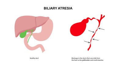 Yeni doğmuş bir bebekte safra kesesi atrezisi. Sağlıklı ve safra kanalları tıkalı. Safra kesesi, karaciğer, fibroz ya da siroz. Hepatoloji, gastroenteroloji ve pediatrik patolojiler, HIDA tarama vektör çizimi.
