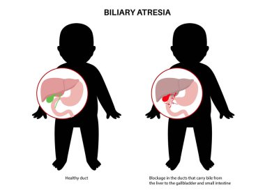 Yeni doğmuş bir bebekte safra kesesi atrezisi. Sağlıklı ve safra kanalları tıkalı. Safra kesesi, karaciğer, fibroz ya da siroz. Hepatoloji, gastroenteroloji ve pediatrik patolojiler, HIDA tarama vektör çizimi.