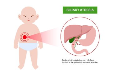 Yeni doğmuş bir bebekte safra kesesi atrezisi. Safra kesesi kanalları, karaciğer ve safra kesesi fibrozu tıkanmış. HIDA taraması hepatoloji, gastroenteroloji ve pediatrik patolojiyle ilgili düz vektör çizimi.