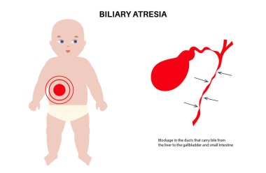 Sarılığı olan yeni doğmuş bir bebeğin safra kesesi atrezimi. Safra kesesi kanalları, karaciğer ve safra kesesi fibrozu tıkanmış. HIDA taraması hepatoloji, gastroenteroloji ve pediatrik patolojiyle ilgili düz vektör çizimi.