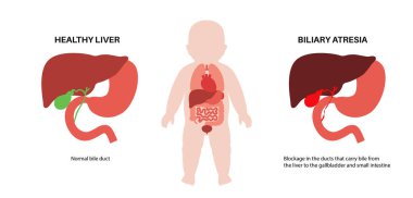 Yeni doğmuş bir bebekte safra kesesi atrezisi. Sağlıklı ve safra kanalları tıkalı. Safra kesesi, karaciğer, fibroz ya da siroz. Hepatoloji, gastroenteroloji ve pediatrik patolojiler, HIDA tarama vektör çizimi.