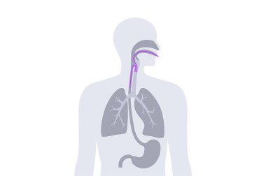 İnsan vücudunda aspirasyon zatürresi. Sıvı ve yiyeceklerle hava yollarının tıkanması, iltihap ve akciğerlerde enfeksiyon. Yutma problemleri, solunum sistemi hastalığı düz vektör çizimi