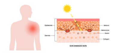 Derideki güneş yanığından kaynaklanan deri hasarı. Zararlı UVB ve UVA ışınlarını emerek deride yaralanmış hücreleri, güneş ışığından dolayı üst deriyi ve derialtı derisini emerek. Melanin ve melanosit vektör anatomik illüstrasyon