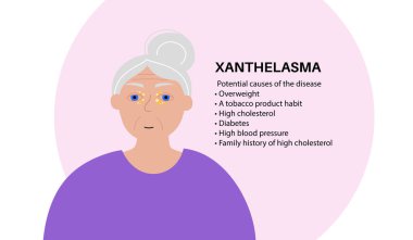 Gözlerinde Xanthelasma var. Göz kapaklarında sarı kolesterol zengin plaklar var. Dermatoloji ve kardiyoloji konsepti. Lipid Diseducation düz vektör çizimi, yaşlı kadın çizgi film karakteri.