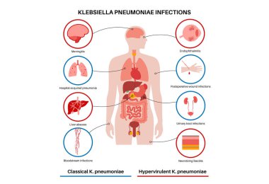 Klebsiella pnömoni teşhisi. Gram negatif, kapsülleşmiş, insan vücudunda fırsatçı patojen. Zatürree, sepsis, karaciğer apsesi. Antibiyotik direnci, biyo-film, bakteri vektör çizimi.
