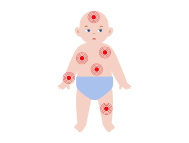 Kırmızı lekeli çocuk silueti acıyı, enfeksiyonu ya da deri durumunu simgeliyor. Hastalığı, rahatsızlığı, iltihabı veya viral hastalığı, düz vektör illüstrasyonunu gösteren pediatrik bebek diyagramı