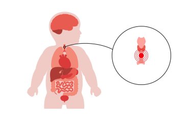 Soluk borusu ve tiroid bezini gösteren çocuk silueti. Pediatrik vektör solunum hastalıklarını, trakeit ve boğmacayı vurguluyor. Hipotiroidizm, guatr, tiroid tiroid bozuklukları. Tıbbi illüstrasyon