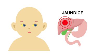 Yeni doğmuş bir vücutta sarılık belirtileri. Sarı deri, gözler ve mukoza zarları, karaciğer yetmezliği, safra kanalı ve safra kesesi anatomisi. Hepatoloji ve pediatri konsepti düz vektör tıbbi çizim.