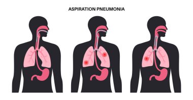 İnsan vücudunda aspirasyon zatürresi. Sıvı ve yiyeceklerle hava yollarının tıkanması, iltihap ve akciğerlerde enfeksiyon. Yutma problemleri, solunum sistemi hastalığı düz vektör çizimi
