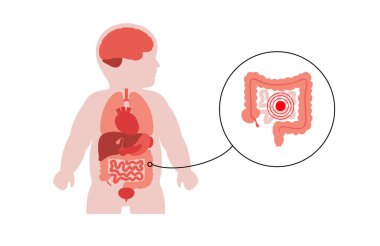 İnce ve kalın bağırsakları olan çocuk silueti anatomik pozisyonda. İshal, kolit, çölyak hastalığı, tıkanıklık gibi sindirim bozuklukları. Bebek vücudundaki bağırsak enfeksiyonları