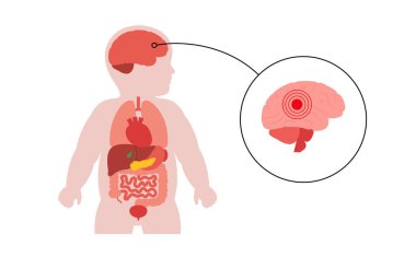 Beyni olan çocuk silueti, pediatrik nörolojik hastalıklar konsepti. Epilepsi, menenjit, otizm, hidrosefali veya tıbbi ve eğitimsel kullanım için beyin geliştirme bozuklukları içeren vektör diyagramı