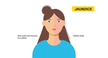 Yeni doğmuş sağlıklı bir bebek ve sarılığı olan bir kadın. Sarı deri, gözler ve mukoza zarları, karaciğer yetmezliği, kadın vücudunda bilirubin. Hepatoloji ve pediatri konsepti düz vektör tıbbi çizim.