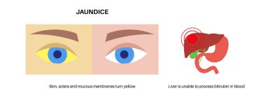 İnsan vücudunda sarılık belirtileri. Sarı deri, gözler ve mukoza zarları, karaciğer yetmezliği, safra kanalı ve safra kesesi anatomisi. Hepatoloji ve pediatri konsepti düz vektör tıbbi çizim.