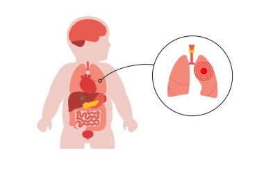 Ciğerleri anatomik pozisyonda olan çocuk silueti. Bronşit, astım, zatürree, RSV enfeksiyonu ya da bebek vücudunda akciğer hastalığı gösteren pediatrik vektör. Eğitim için tıbbi düz illüstrasyon