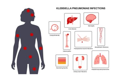 Klebsiella pnömoni teşhisi. Gram negatif, kapsülleşmiş, insan vücudunda fırsatçı patojen. Zatürree, sepsis, karaciğer apsesi. Antibiyotik direnci, biyo-film, bakteri vektör çizimi.