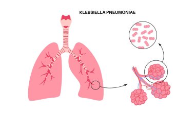 Klebsiella pnömoni posteri. Gramnegatif, kapsülleşmiş, pulmoner alveolde fırsatçı patojen. Zatürree, sepsis ve karaciğer apsesi. Antibiyotik direnci ve biyofilm bakteri vektörü oluşturur
