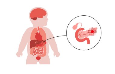 Anatomik pozisyonda pankreası olan çocuk silueti. Bebeklerde endokrin ve sindirim sistemini gösteren pediatrik vektör. Bebek vücudunda diyabet, pankreatit, enzim bozuklukları ve metabolik hastalıklar